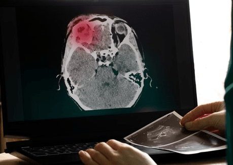 doctor looking at scan of brain injury